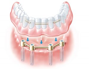 dentures over implants