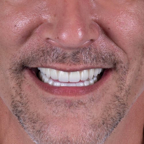 Dental Implants Desert Dental Nogales